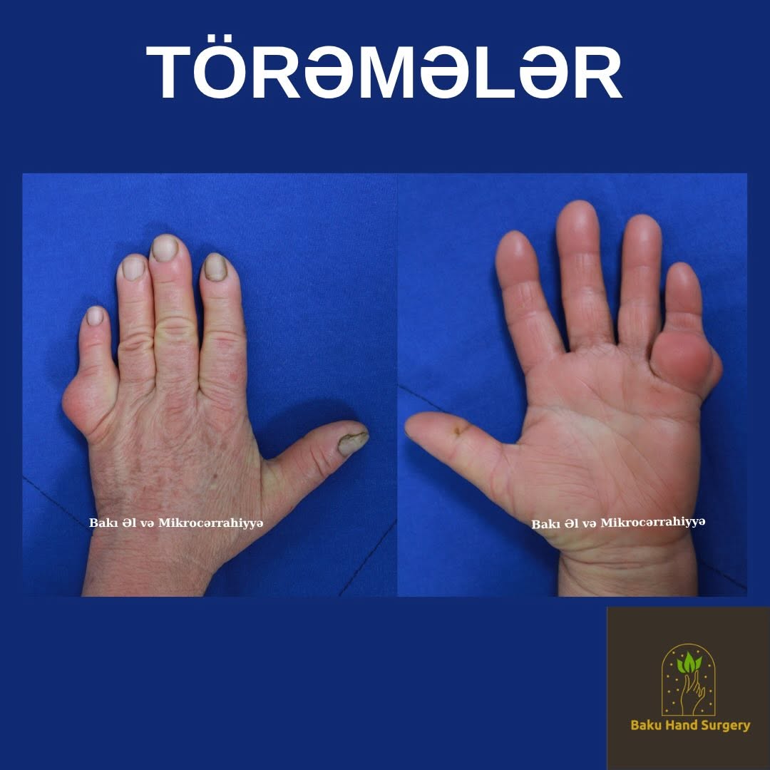 TÖRƏMƏLƏR Əldə ən çox rast gəlinən problemlərdən biri törəmələrdir. Onlar bəzən ağrılı, bəzən isə səssiz şəkildə böyüyən şişliklər kimi özünü göstəri…